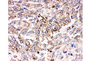 Anti-Smad1 antibody, IHC(P) IHC(P): Human Lung Cancer Tissue (SMAD1 Antikörper  (C-Term))