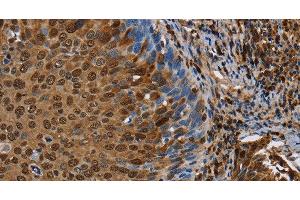 Immunohistochemistry of paraffin-embedded Human cervical cancer tissue using NRP2 Polyclonal Antibody at dilution 1:45 (NRP2 Antikörper)
