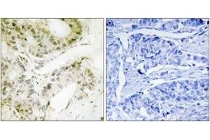 Immunohistochemistry analysis of paraffin-embedded human lung carcinoma, using MED13 Antibody.