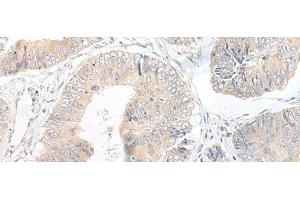 Immunohistochemistry of paraffin-embedded Human colorectal cancer tissue using LYRM2 Polyclonal Antibody at dilution of 1:50(x200) (LYRM2 Antikörper)