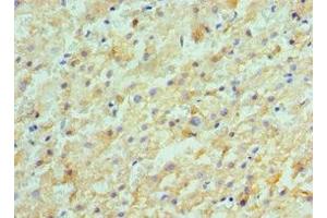 Immunohistochemistry of paraffin-embedded human liver cancer using ABIN7143180 at dilution of 1:100
