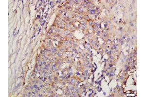 Formalin-fixed and paraffin embedded human lung carcinoma labeled with Rabbit Anti-Factor D/Adipsin Polyclonal Antibody, Unconjugated (ABIN1713782) at 1:200 followed by conjugation to the secondary antibody and DAB staining (Adipsin Antikörper  (AA 21-120))