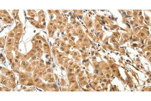 Immunohistochemistry of paraffin-embedded Human lung cancer tissue using MAP1A Polyclonal Antibody at dilution 1:40 (MAP1A Antikörper)