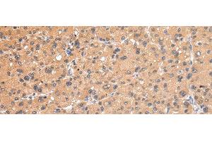 Immunohistochemistry of paraffin-embedded Human liver cancer using AP2A1 Polyclonal Antibody at dilution of 1/20 (alpha Adaptin Antikörper)