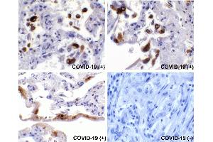Immunohistochemical analysis of paraffin-embedded COVID-19 patient lung tissue using anti-SARS-CoV-2 (COVID-19) Spike S2 antibody (ABIN1030641, 0. (SARS-CoV-2 Spike Antikörper  (C-Term))
