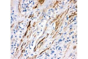 IHC-P: Fas antibody testing of human lung cancer tissue (FAS Antikörper  (AA 26-173))