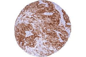 Urothelial carcinoma of the urinary bladder Invasive with moderate to strong TYMS staining of tumor cells (Rekombinanter TYMS Antikörper  (Center))