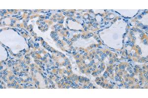 Immunohistochemistry of paraffin-embedded Human thyroid cancer tissue using NEK5 Polyclonal Antibody at dilution 1:60 (NEK5 Antikörper)
