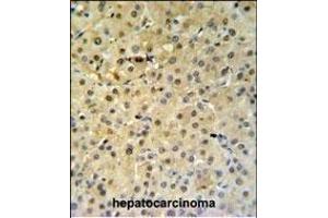 PSME1 Antibody (C-term) (ABIN651448 and ABIN2840245) IHC analysis in formalin fixed and paraffin embedded hepatocarcinoma followed by peroxidase conjugation of the secondary antibody and DAB staining.