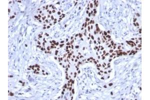 ABIN6383817 to TP53 was successfully used to stain human breast carcinoma sections. (Rekombinanter p53 Antikörper)