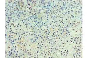 Immunohistochemistry of paraffin-embedded human breast cancer using ABIN7167500 at dilution of 1:100 (PTPRA Antikörper  (AA 20-142))