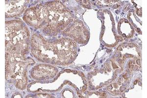ABIN6267702 at 1/100 staining human kindey carcinoma tissue sections by IHC-P. (CAMK2B Antikörper  (pThr286))