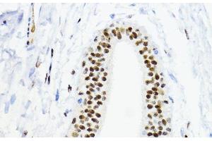 Immunohistochemistry of paraffin-embedded Human mammary cancer using ZEB1 Polyclonal Antibody at dilution of 1:200 (40x lens). (ZEB1 Antikörper)