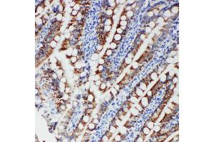 Anti-FER antibody, IHC(P) IHC(P): Human Intestinal Cancer Tissue (FER Antikörper  (Middle Region))