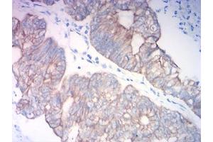 Immunohistochemical analysis of paraffin-embedded colon cancer tissues using KRT18 mouse mAb with DAB staining. (Cytokeratin 18 Antikörper  (AA 1-150))