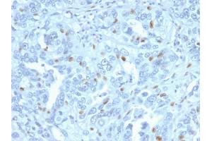 Formalin-fixed, paraffin-embedded human Endometrial Carcinoma stained with Cyclin A2 Mouse Monoclonal Antibody (CCNA2/2333). (Cyclin A Antikörper)