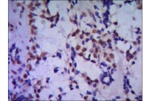 IHC of paraffin-embedded huma breast cancer using anti-TBLR1 mouse mAb diluted 1/500-1/1000 (TBL1XR1 Antikörper)