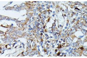 Immunohistochemistry of paraffin-embedded Human lung cancer using MAP3K3 Polyclonal Antibody at dilution of 1:100 (40x lens). (MAP3K3 Antikörper)