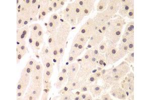 Immunohistochemistry of paraffin-embedded Human liver cancer using UHRF2 Polyclonal Antibody at dilution of 1:200 (40x lens).