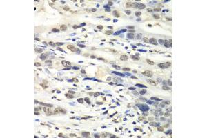 Immunohistochemistry of paraffin-embedded human gastric cancer using NUDT1 antibody (ABIN6292587) at dilution of 1:100 (40x lens). (NUDT1 Antikörper)