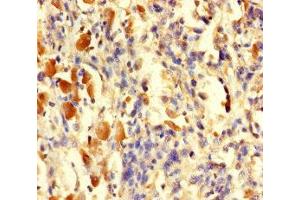 Immunohistochemistry of paraffin-embedded human melanoma using ABIN7166593 at dilution of 1:100 (TGFA Antikörper  (AA 40-89))