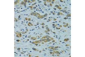 Immunohistochemistry of paraffin-embedded human gastric cancer using STX1A antibody (ABIN1876774) at dilution of 1:100 (40x lens). (STX1A Antikörper)