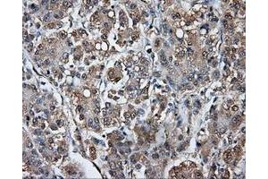 Immunohistochemical staining of paraffin-embedded Carcinoma of liver tissue using anti-TPMT mouse monoclonal antibody. (TPMT Antikörper)