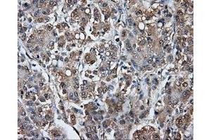 Immunohistochemical staining of paraffin-embedded Carcinoma of liver tissue using anti-TPMT mouse monoclonal antibody.