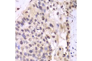 Immunohistochemistry of paraffin-embedded human lung cancer using PSMA6 antibody at dilution of 1:100 (400x lens). (PSMA6 Antikörper)