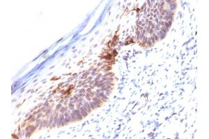 Formalin-fixed, paraffin-embedded human Skin stained with CD1a Monoclonal Antibody (SPM120). (CD1a Antikörper)