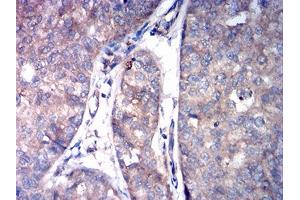 Immunohistochemical analysis of paraffin-embedded bladder cancer tissues using ASGR2 mouse mAb with DAB staining. (Asialoglycoprotein Receptor 2 Antikörper  (AA 80-311))
