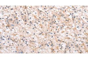 Immunohistochemistry of paraffin-embedded Human renal cancer using MMP11 Polyclonal Antibody at dilution of 1:40 (MMP11 Antikörper)