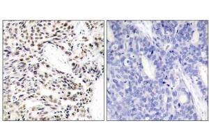Immunohistochemical analysis of paraffin-embedded human breast carcinoma tissue using NF-κB p65 (Ab-529) antibody (E021210). (NF-kB p65 Antikörper)