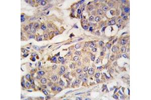 IHC analysis of FFPE human breast carcinoma tissue stained with ACO2 antibody (ACO2 Antikörper  (AA 294-325))