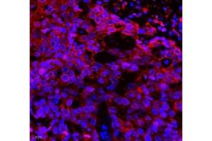Immunofluorescence of paraffin embedded human esophagus cancer using Neil1 (ABIN7073820) at dilution of 1: 300 (400x lens) (NEIL1 Antikörper)