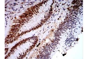 Immunohistochemical analysis of paraffin-embedded colon cancer tissues using KDM1A mouse mAb with DAB staining. (LSD1 Antikörper  (AA 55-263))