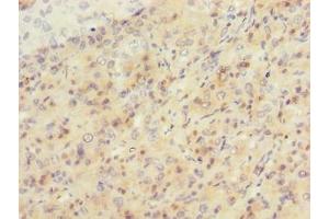 Immunohistochemistry of paraffin-embedded human liver cancer using ABIN7169695 at dilution of 1:100