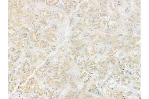 p38 MAPK Antibody at 1/100 staining human renal cell carcinoma by IHC-P.