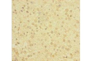 Immunohistochemistry of paraffin-embedded human glioma using ABIN7143220 at dilution of 1:100 (Diazepam Binding Inhibitor Antikörper  (AA 2-105))