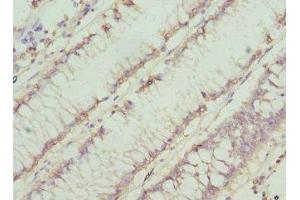 Immunohistochemistry of paraffin-embedded human colon cancer using ABIN7160753 at dilution of 1:100 (CHN1 Antikörper  (AA 1-200))