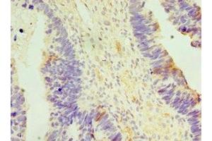 Immunohistochemistry of paraffin-embedded human ovarian cancer using ABIN7150151 at dilution of 1:100 (APOBEC3C Antikörper  (AA 1-190))