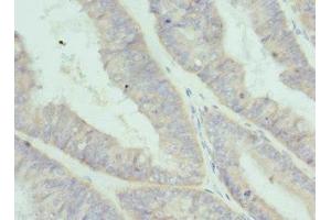 Immunohistochemistry of paraffin-embedded human endometrial cancer using ABIN7156846 at dilution of 1:100 (IL-2 Antikörper  (AA 25-176))