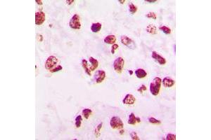 Immunohistochemical analysis of SNAI1 staining in human lung cancer formalin fixed paraffin embedded tissue section. (SNAIL Antikörper  (C-Term))