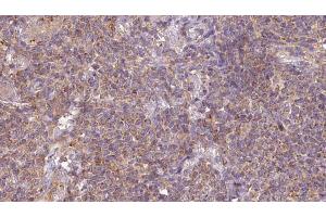 ABIN6273201 at 1/100 staining Human lymph cancer tissue by IHC-P. (ARL6 Antikörper  (Internal Region))