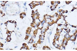 Immunohistochemistry of paraffin-embedded Human thyroid cancer using MAOA Polyclonal Antibody at dilution of 1:100 (40x lens). (Monoamine Oxidase A Antikörper)