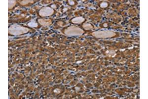 The image on the left is immunohistochemistry of paraffin-embedded Human thyroid cancer tissue using ABIN7190808(GJB4 Antibody) at dilution 1/40, on the right is treated with synthetic peptide. (GJB4 Antikörper)