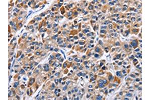 The image on the left is immunohistochemistry of paraffin-embedded Human liver cancer tissue using ABIN7129371(ENPP5 Antibody) at dilution 1/40, on the right is treated with fusion protein. (ENPP5 Antikörper)