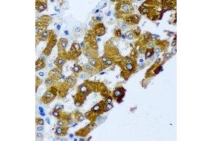 Immunohistochemical analysis of KIF3A staining in human liver cancer formalin fixed paraffin embedded tissue section. (KIF3A Antikörper)