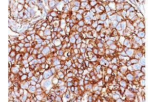 Formalin-fixed, paraffin-embedded human Breast Carcinoma stained with CD44 Mouse Monoclonal Antibody (HCAM/918). (CD44 Antikörper)