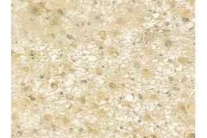 ABIN6259963 and ABIN6277562 at 1/100 staining human astrocytoma by IHC-P.